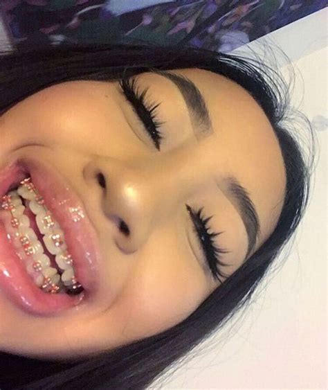 braces pinterest|girl with braces aesthetic.